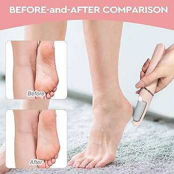 Flawless Electric Foot Callus Remover